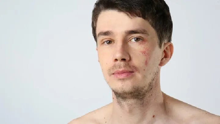 常见几种胎记的分类和症状