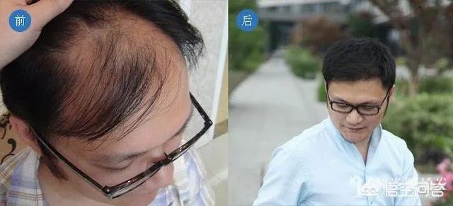 鲁尼植发这件事，大家这么看？