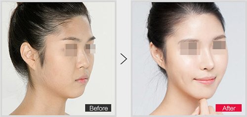 玻尿酸隆鼻大概多少钱