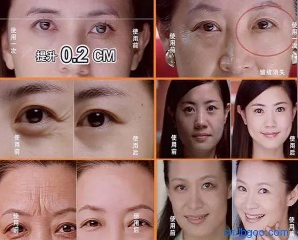 尼蔻微电波拉皮去皱美容仪的特点