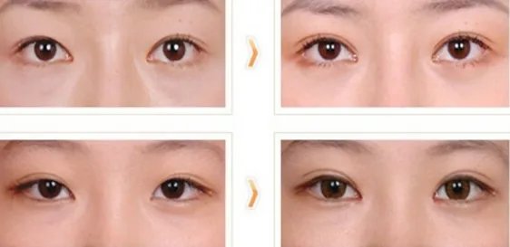 割双眼皮前后效果