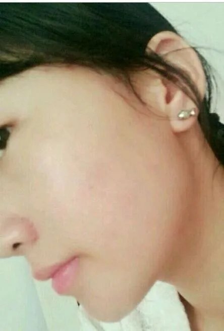 遗传斑点怎么去除？