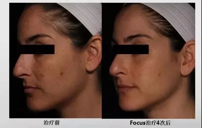 光子嫩肤祛斑的价格是多少