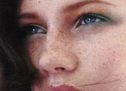 遗传斑点怎么去除？