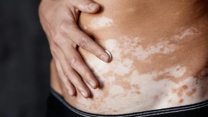 贵州白癜风医院：白癜风的治疗方法