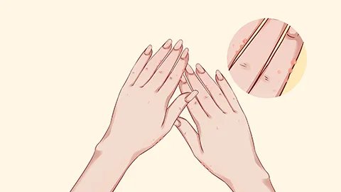 肛门湿疹什么症状