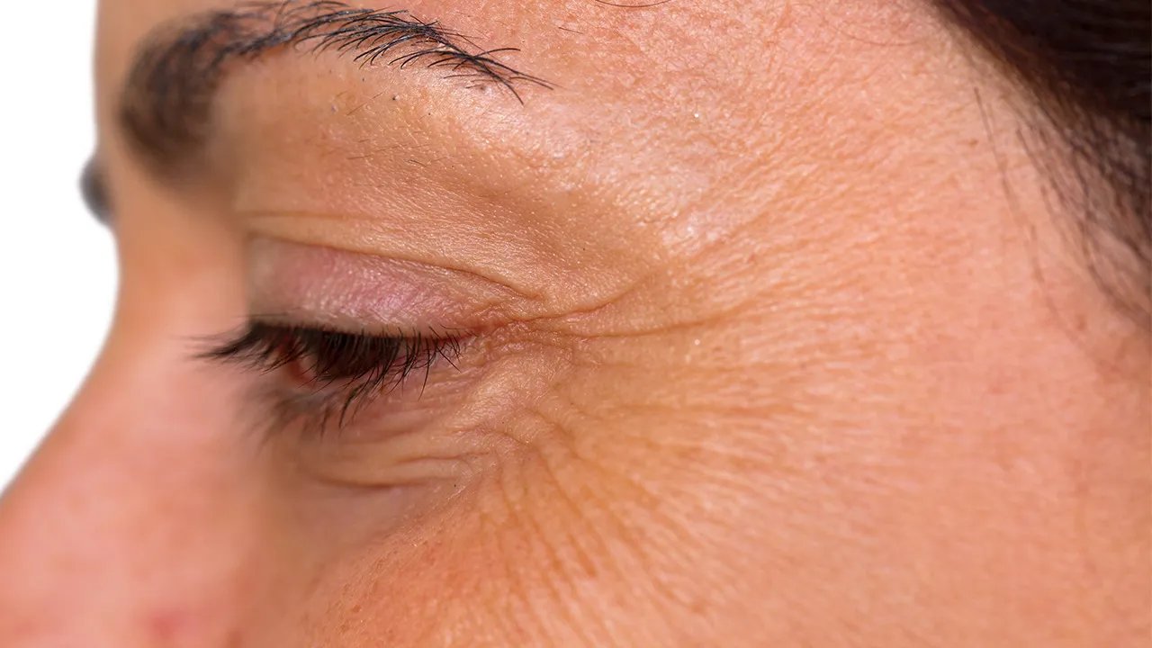 眼角皱纹如何去除