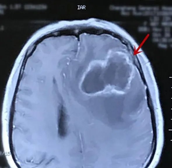 女子收养流浪猫狗感染细菌是真的吗？