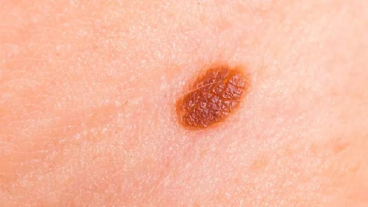 常见几种胎记的分类和症状