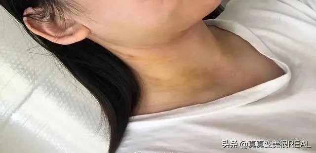 面部吸脂效果好吗？