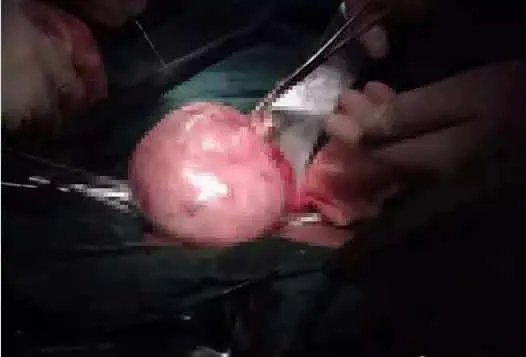 长了30年的瘤子切开后竟是这样（图）