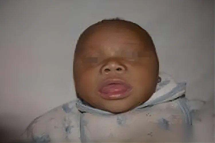 发育迟缓特殊面容的孩子图片