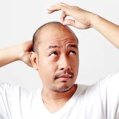 斑秃的治疗方法有哪些