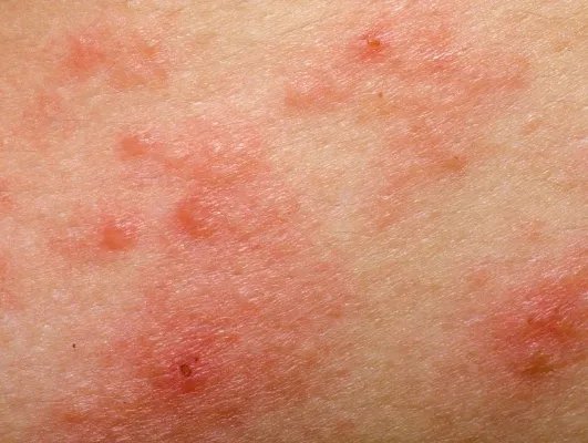 治疗荨麻疹的药物有哪些