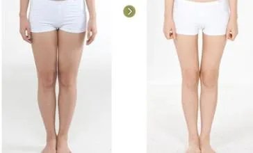 大腿吸脂手术多少钱