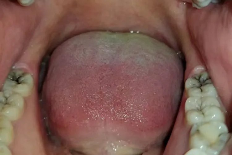 龋病牙齿症状图片