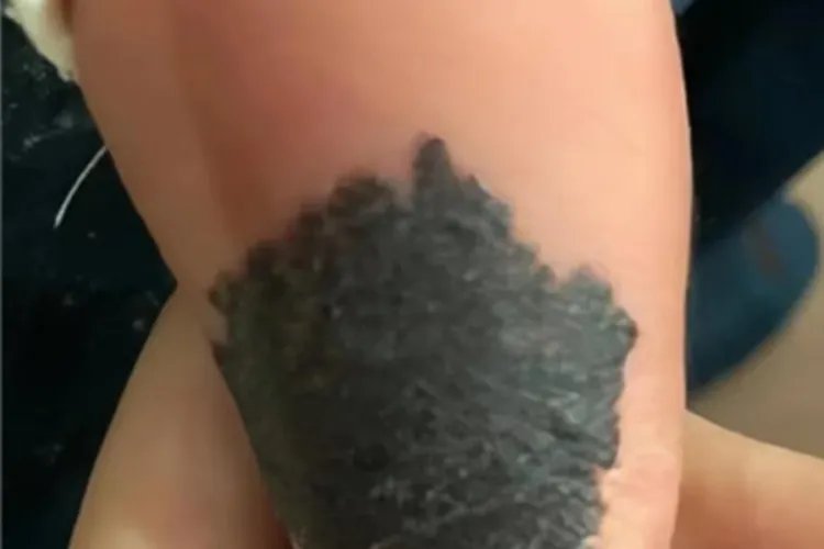 兽皮痣小腿黑斑图片