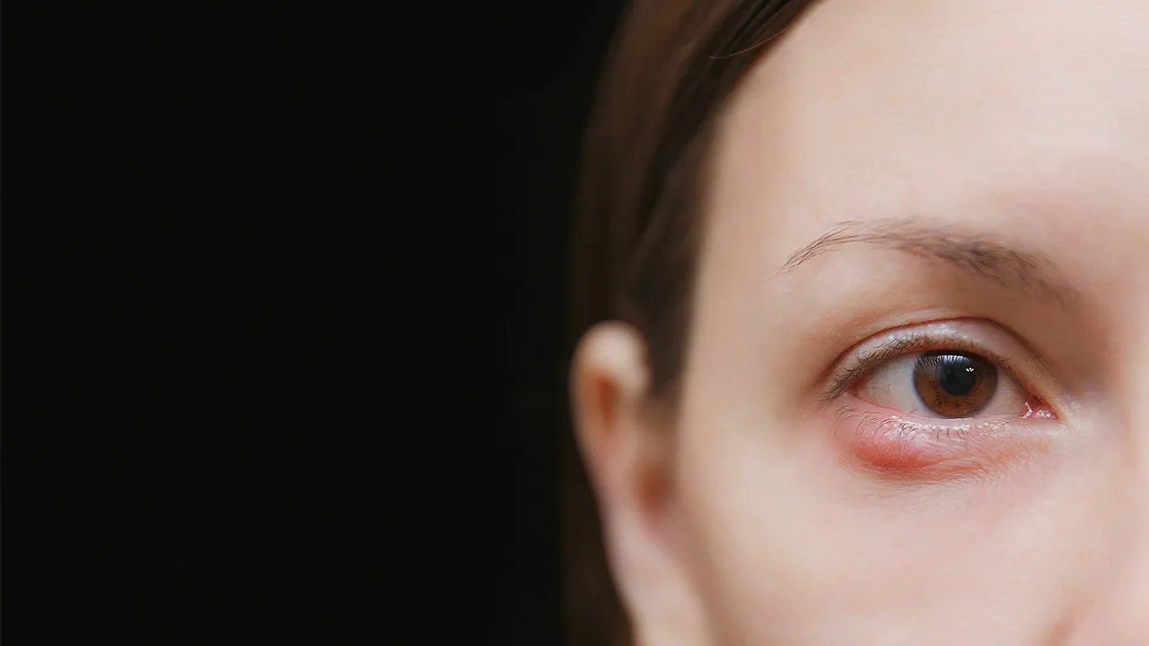 怎样消除眼角细纹