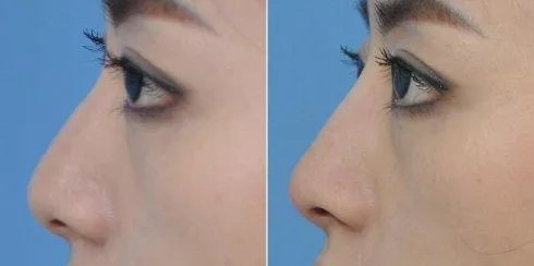 做玻尿酸隆鼻费用多少钱