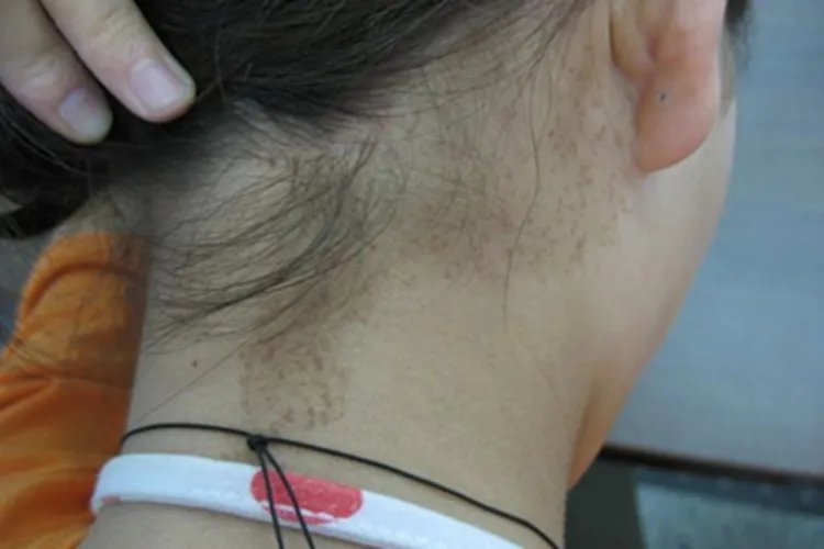日光性雀斑样痣后颈斑图片