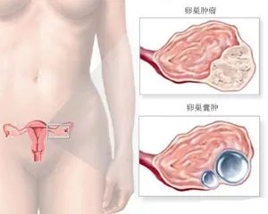 卵巢出血怎么办