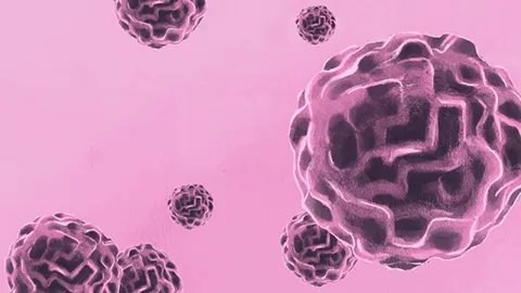 肾癌晚期如何治疗