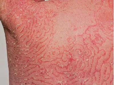 叠瓦癣脱皮图片