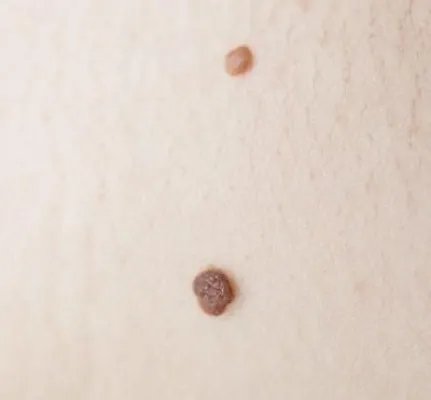 黑痣发痒是怎么回事 黑痣发痒与两个原因有关