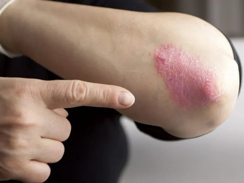 牛皮藓的症状有哪些