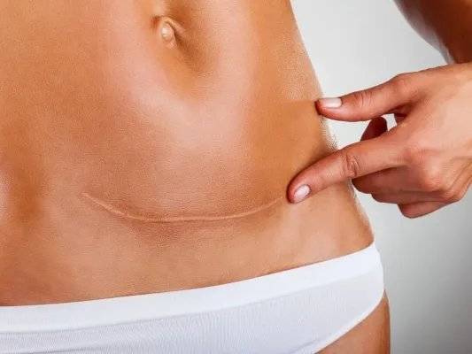 剖腹产后的饮食