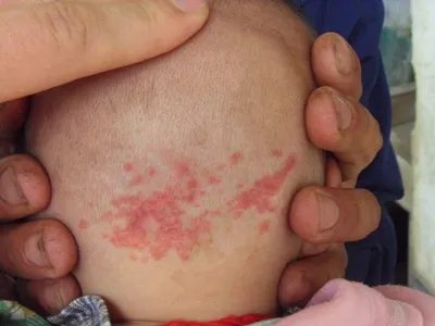 弥漫性躯体性血管角化瘤后脑勺症状图片