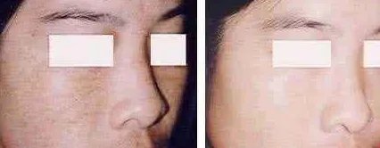 上海激光祛斑多少钱