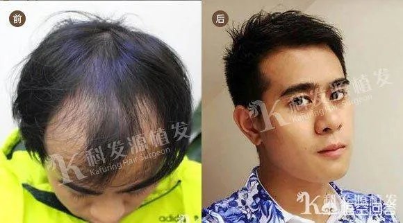 鲁尼植发这件事，大家这么看？