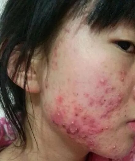 遗传斑点怎么去除？