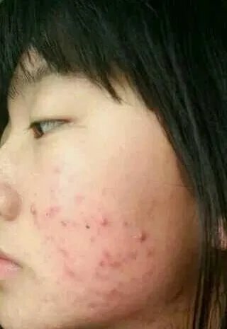 遗传斑点怎么去除？