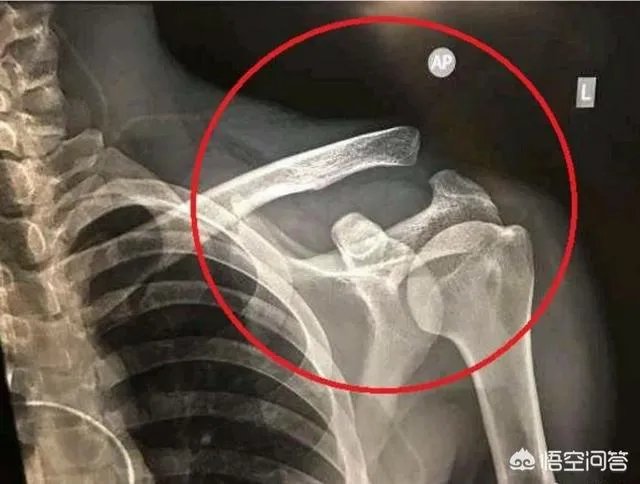 西班牙人官宣：武磊伤势很轻，不影响出战西甲，真是打脸国内医生，你怎么看？