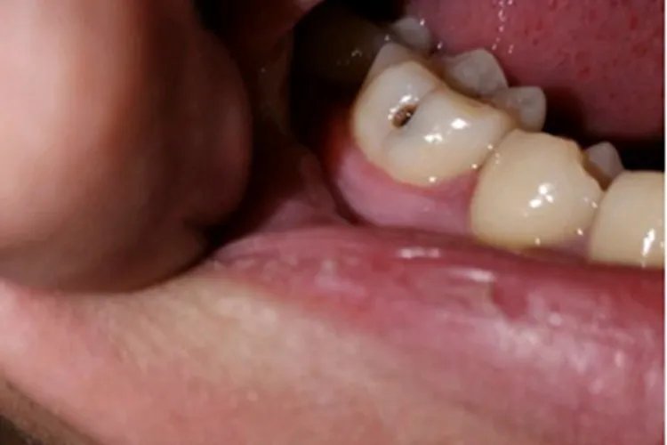 龋病牙齿症状图片