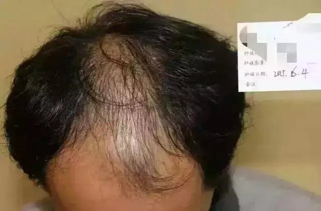 鲁尼植发这件事，大家这么看？