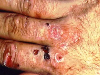 迟发性皮肤卟啉病手部脱屑图片