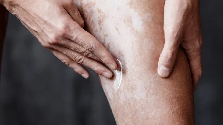 贵州白癜风医院：白癜风的治疗方法