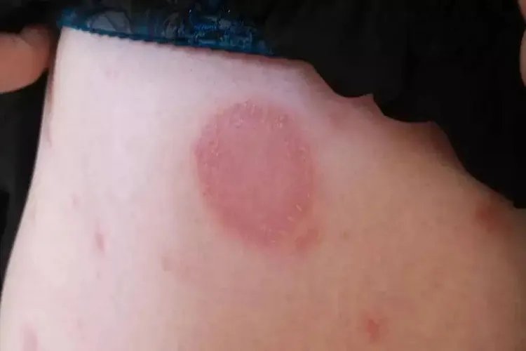 玫瑰糠疹全过程图片