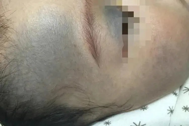 宝宝肤色不均匀图片