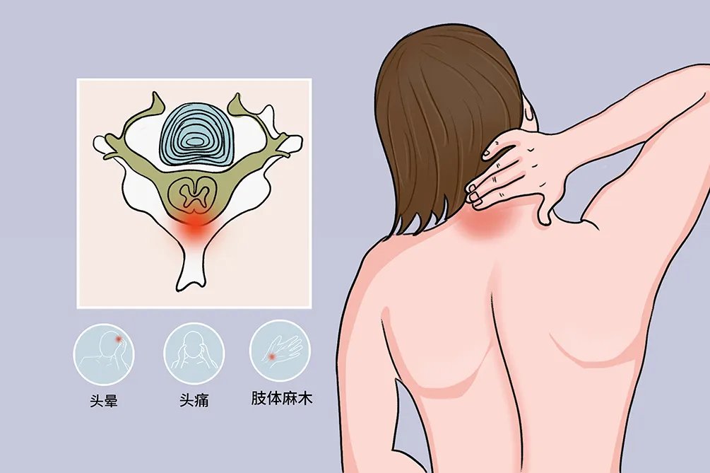 颈椎病会引起哪些不适症状图片