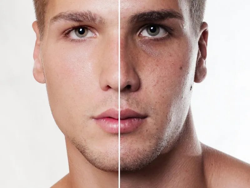 ve能去痘印的方法