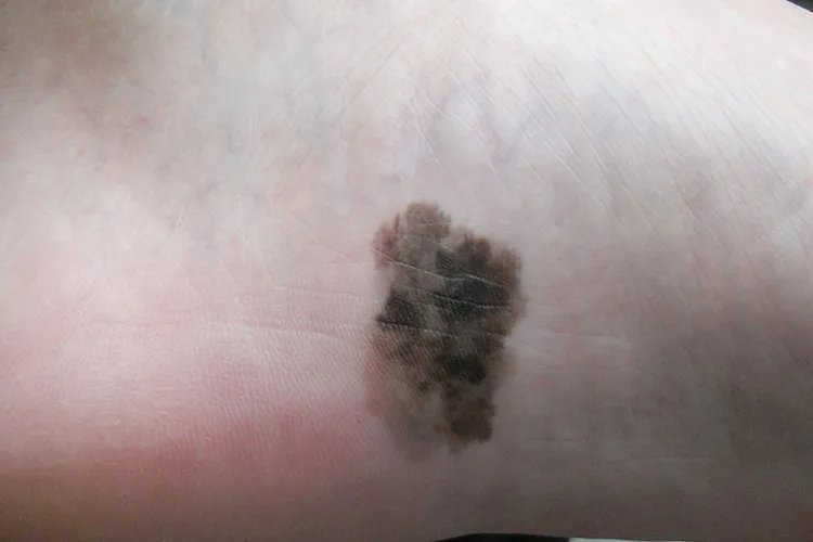 皮肤癌的症状与表现图片