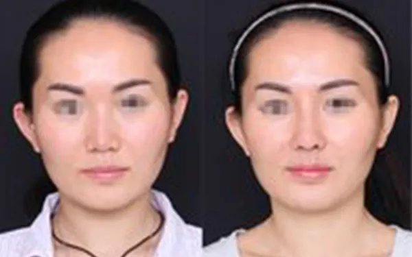 胶原蛋白隆鼻多少钱