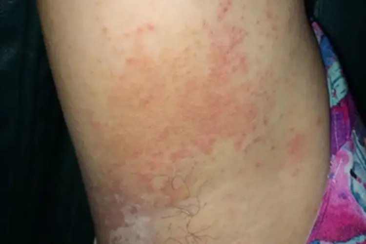 间擦疹腋窝丘疹图片