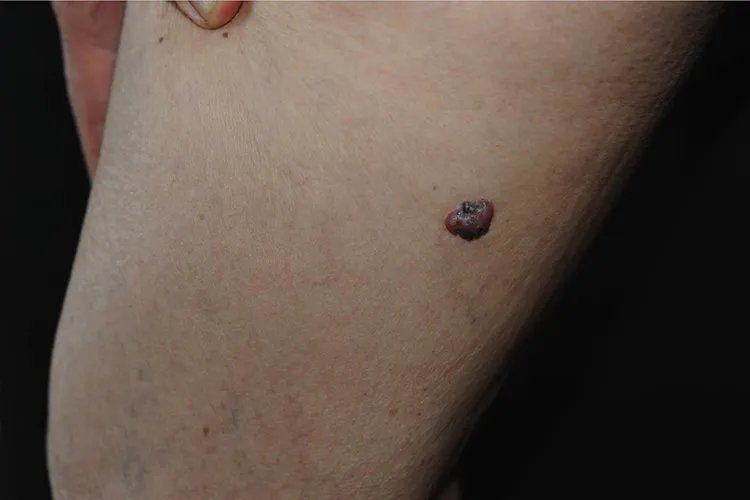 皮肤癌的症状与表现图片