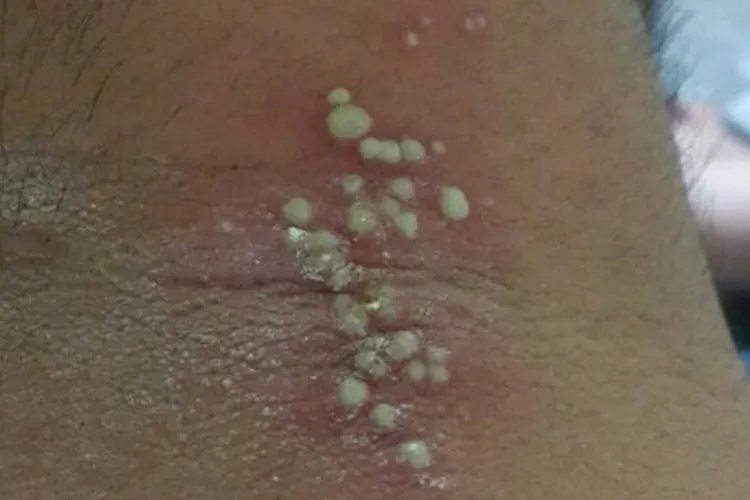 大人痱子症状图片