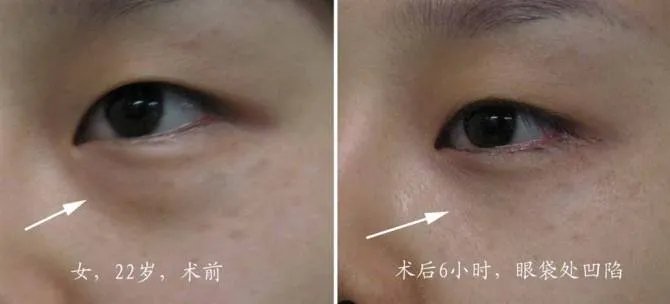 超声法去眼袋的价格